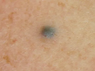 الشامات الزرقاء (Blue nevi)