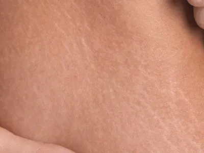 السيلوليت المائي (Aqueous Cellulite)