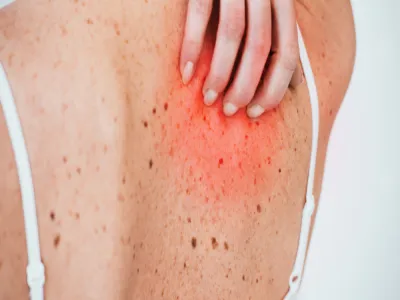 أسباب حكة الجسم المفاجئة عند المرأة