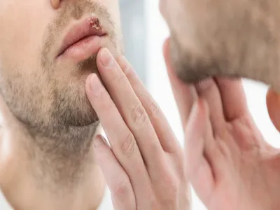 تورم الشفاه بسبب السرطان