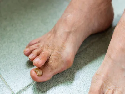أعراض سعفة القدم