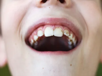 2. تسوس المينا أو تآكل المينا 