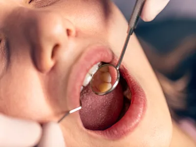 5. تكون خراج الأسنان