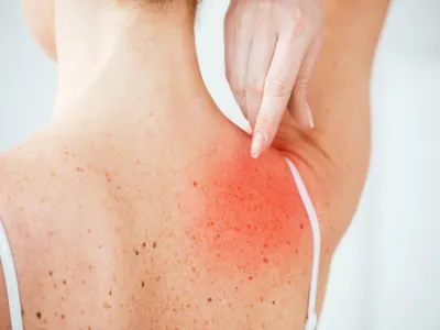 أعراض أخرى لقرصة البق