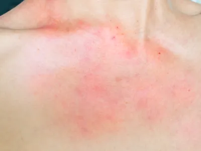 5. مدة استمرار الأعراض