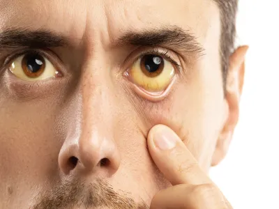 أعراض تليف الكبد