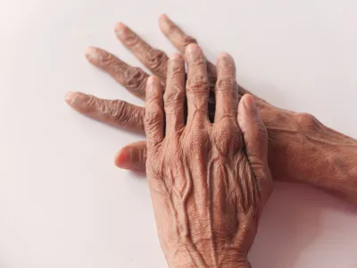 أعراض الجذام