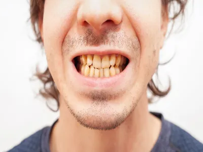 5. أضرار التدخين على الفم والأسنان