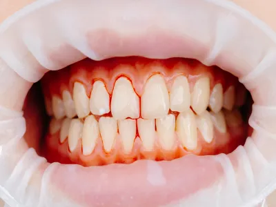1. التهاب اللثة