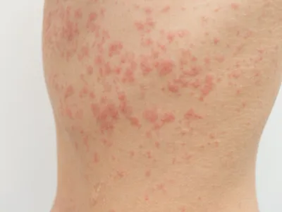 أعراض المليساء المعدية