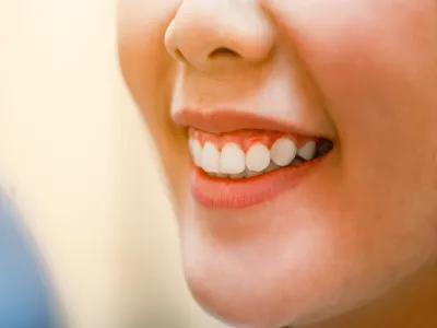 5. تضخم اللثة