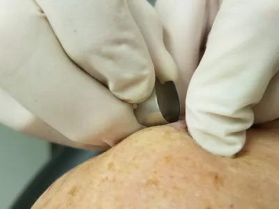 علاج المليساء المعدية