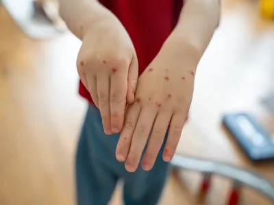 أين تظهر حبوب جدري القردة؟