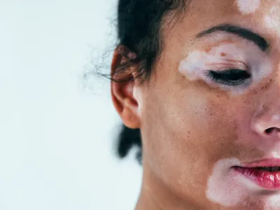 1. البهاق يُسبب بقعًا بيضاء في مناطق محددة
