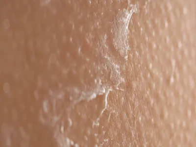 تشخيص جلد الدجاجة