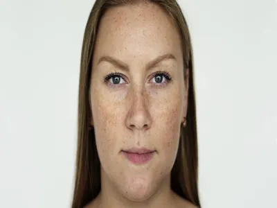 5 أشياء يجب أن تعرفها عن الكلف