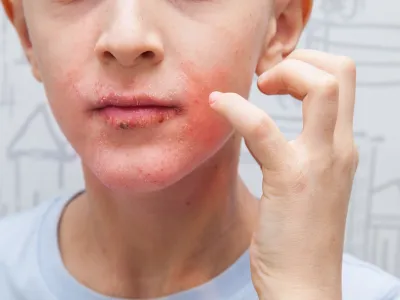 1. الأكزيما (Eczema)