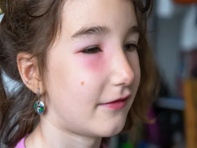 4. الوذمة الوعائية (Angioedema)