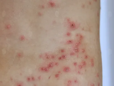 أعراض الإيدز على الجلد