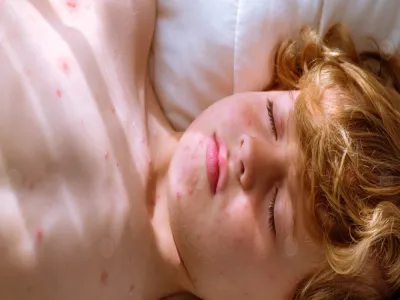 عزل صحي في أمريكا بسبب الحصبة!