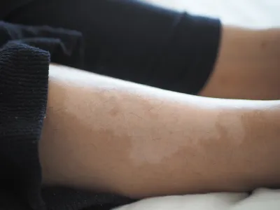 كيف يكون مظهر البُهاق في بدايته؟