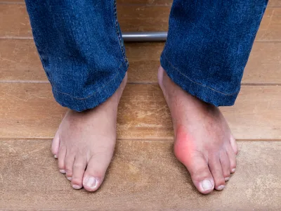 أعراض النقرس