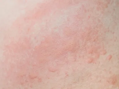 1. التهاب الجلد التماسي (Contact dermatitis)