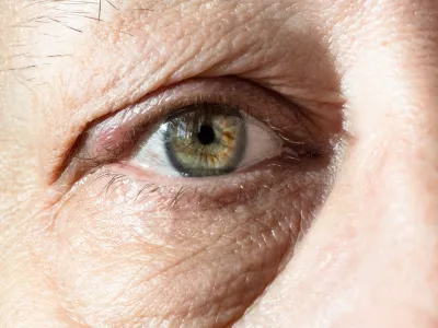 6. اللويحة الصفراء (Xanthelasma)