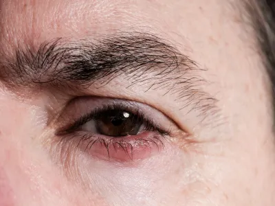 1. التهاب الجفن (Blepharitis)