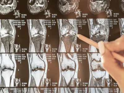 سرطان العظام بالصور: الأعراض والأسباب والعلاج