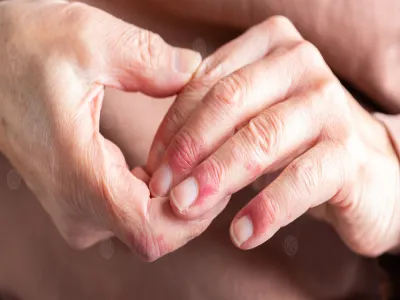 علاج التهاب الإصبع حول الظفر في المنزل 