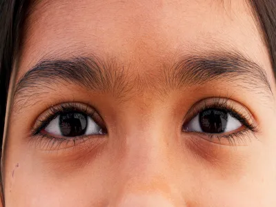6. الحول (Strabismus)