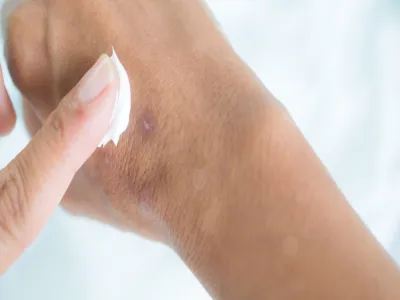 أفضل كريم للفطريات الجلدية