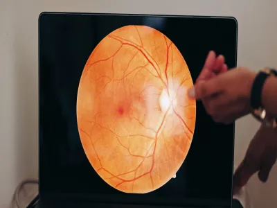 3. اعتلال الشبكية السكري (Diabetic retinopathy)