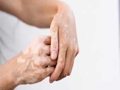 الفرق بين نقص التصبغ والبهاق 