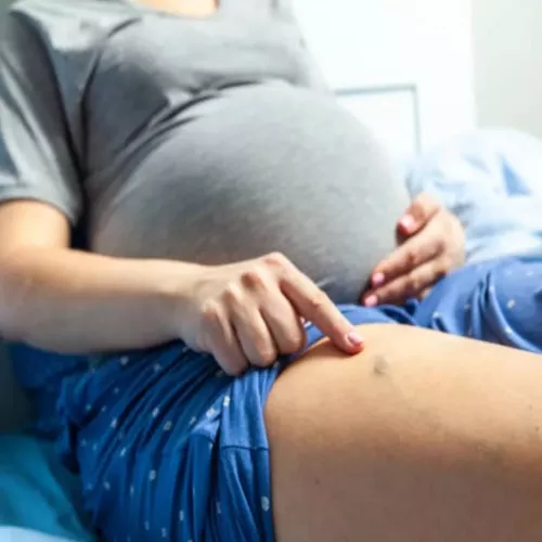 دوالي الساقين أثناء الحمل