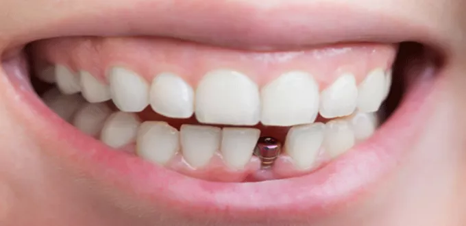 ما هي انواع تركيب الاسنان واسبابه وطرقه واضراره | الطبي