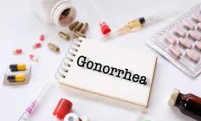 مرض السيلان