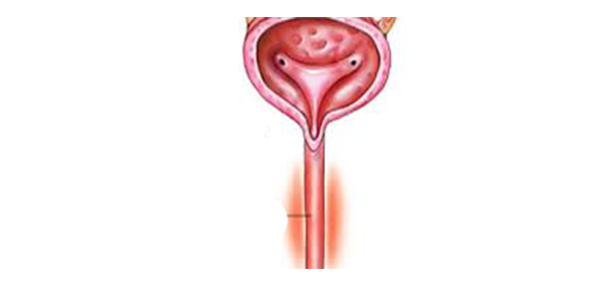 التهاب الاحليل السيلاني