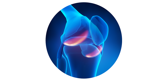 التهاب المفصل النقرسي