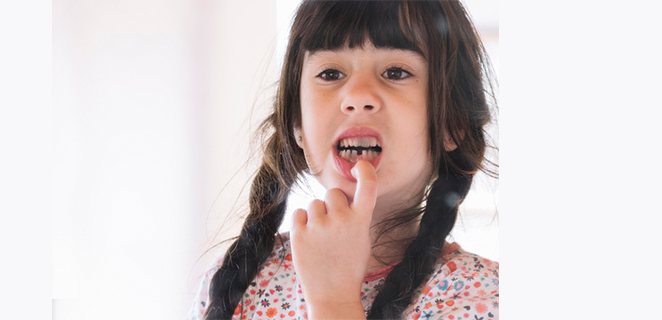 تسوس الاسنان الامامية