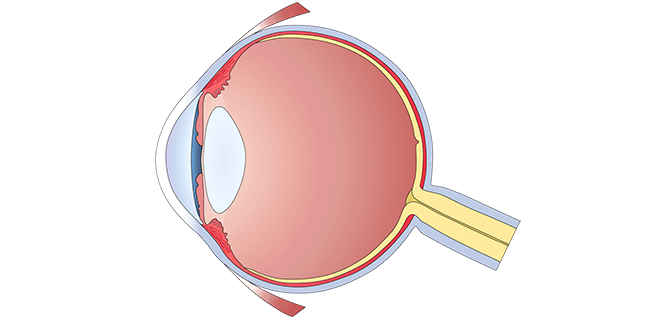 اغتراس القرنية