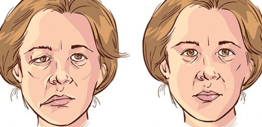 اعتلال العصب السابع