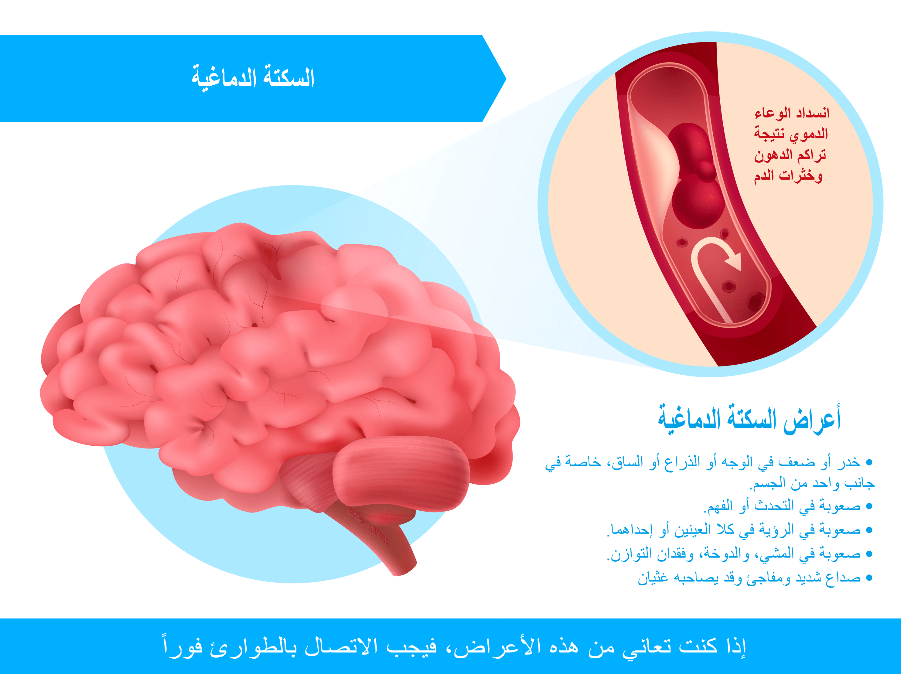 انغوغرافيك السكتة الدماغية