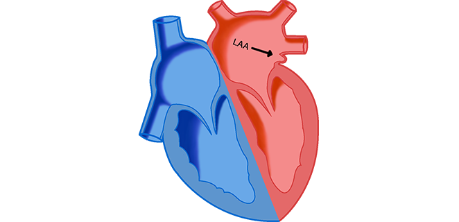 عيب الحاجز الاذيني