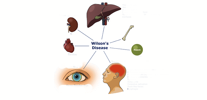 مرض ويلسون