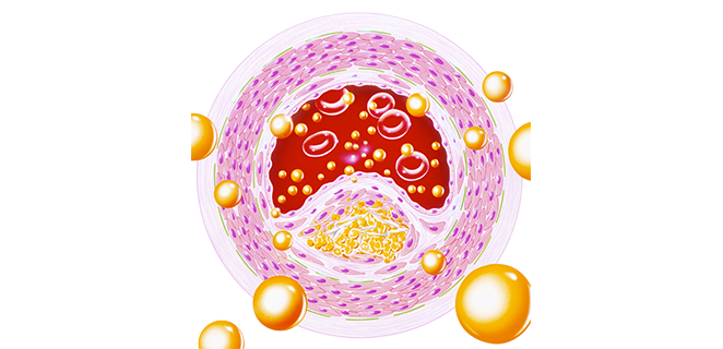 تصلب شرياني