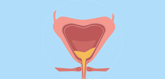 توسع المثانة