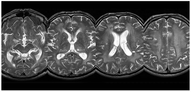 التهاب بيضاء الدماغ