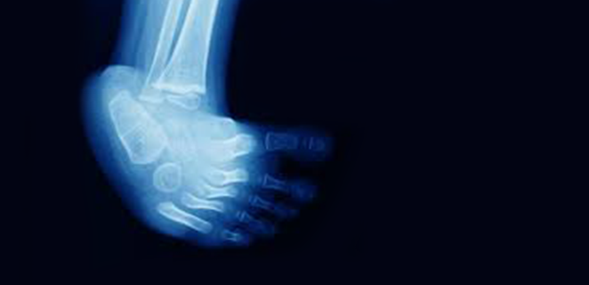 اعوجاج المفاصل الولادي